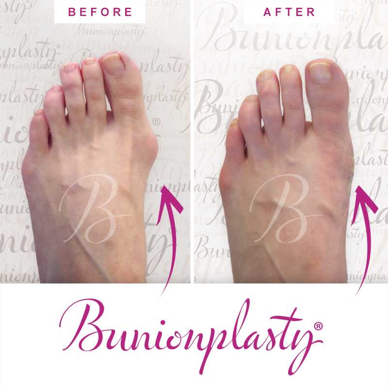 Bunionplasty Before & After Patient 59