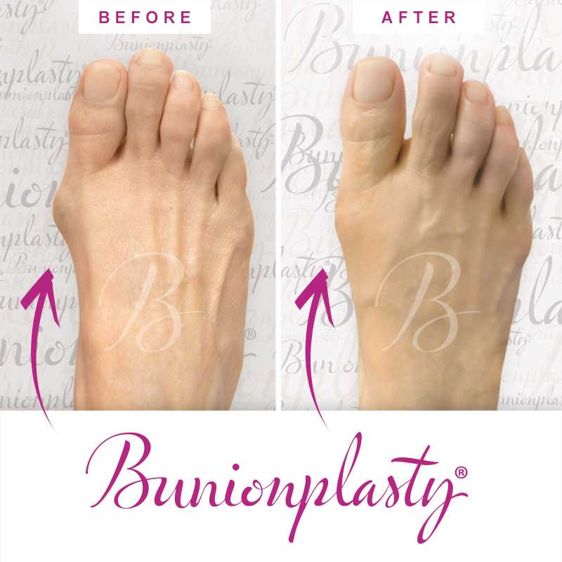 Bunionplasty Before & After Patient 60