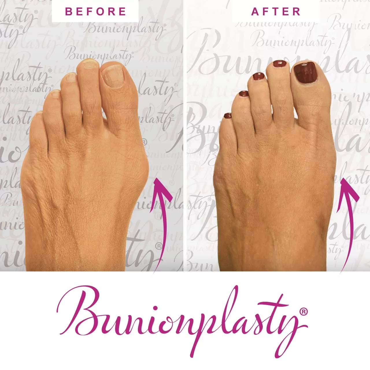 Bunionplasty Procedure Before & After Image 02