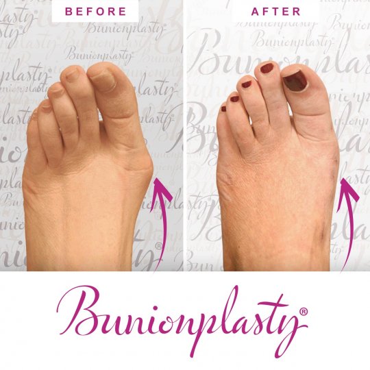 Bunionplasty Procedure Before & After Image 03