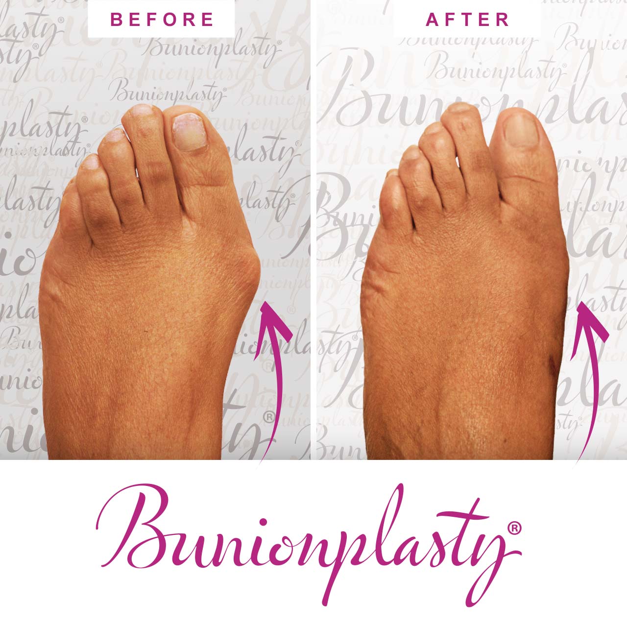 Bunionplasty Procedure Before & After Image 04