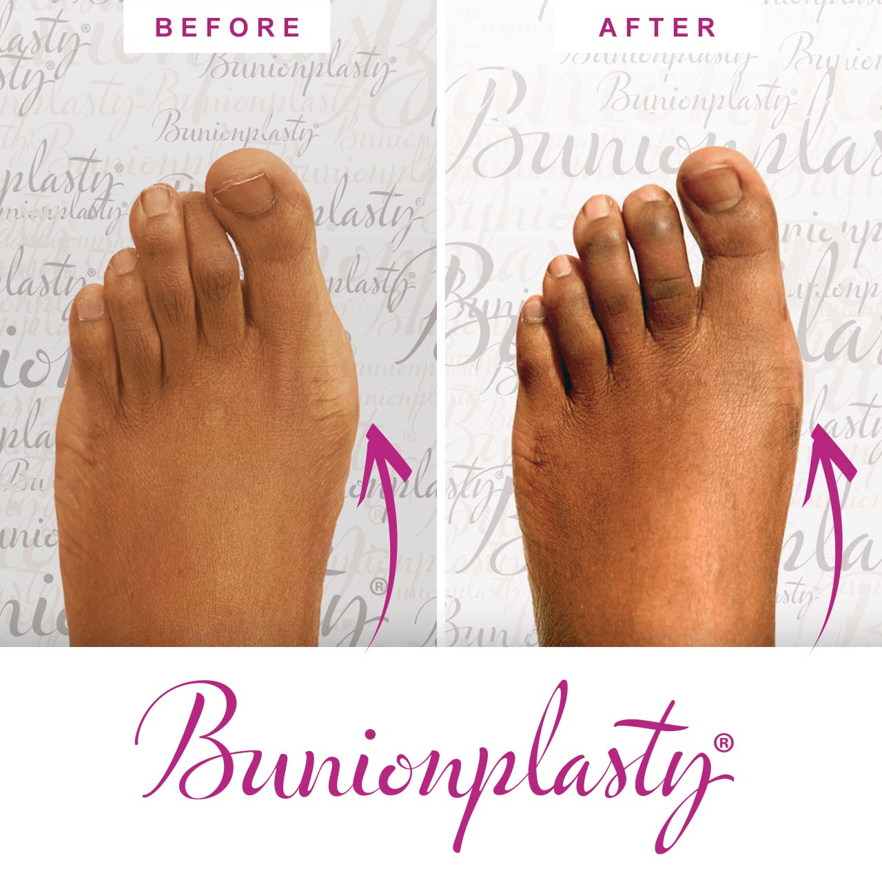 Bunionplasty Procedure Before & After Image 05