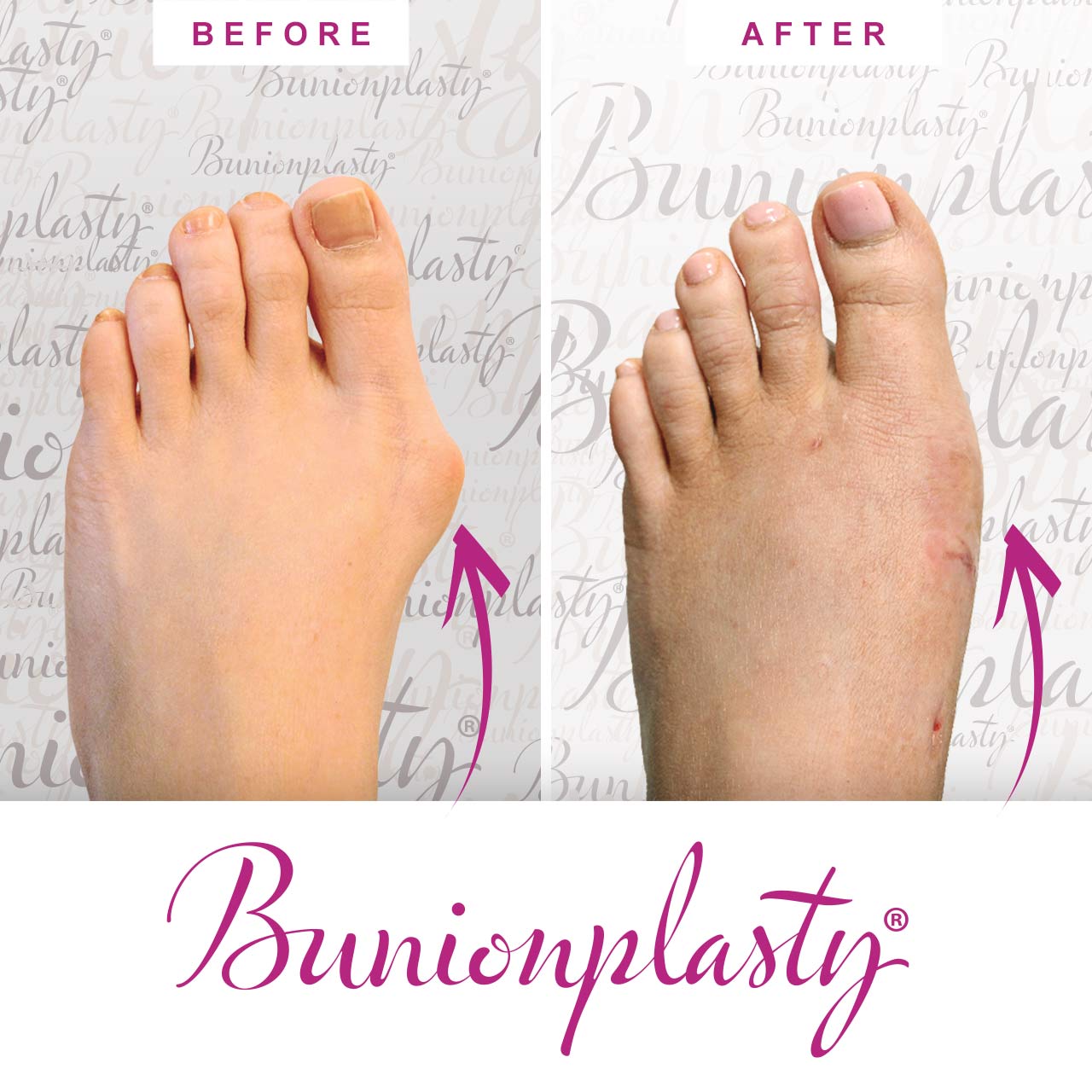 Bunionplasty Procedure Before & After Image 06