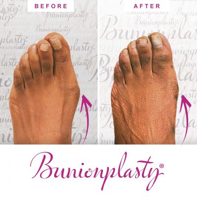 Bunion Surgery Before & After Gallery
