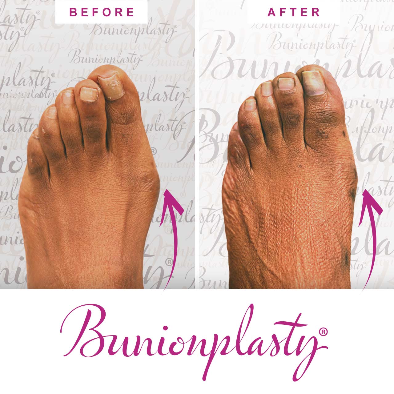 Bunionplasty Procedure Before & After Image 08