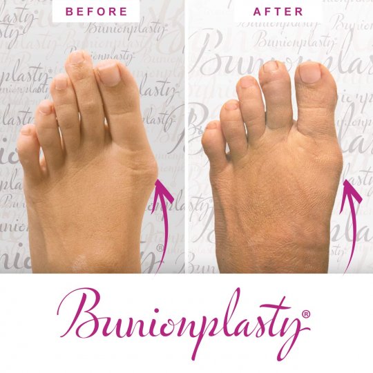 Bunionplasty Procedure Before & After Image 10