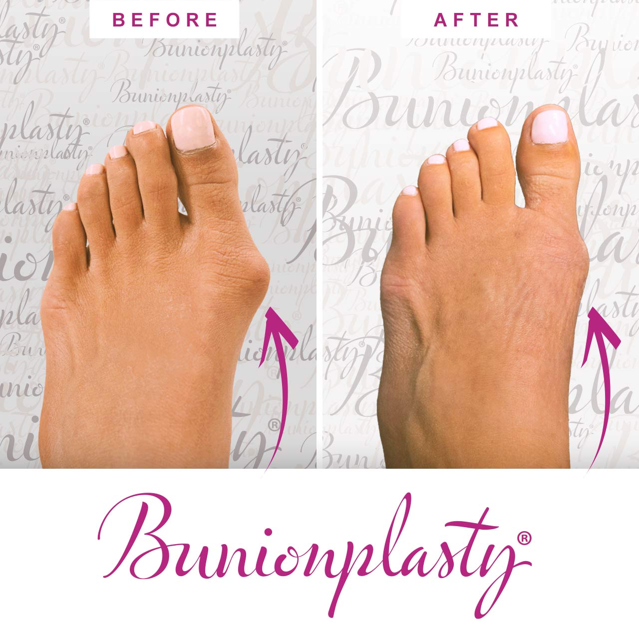 Bunionplasty Procedure Before & After Image 11