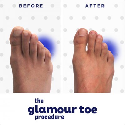 Glamour Toe Procedure Before & After Image 02