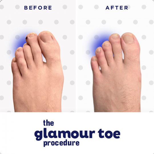 GlamourToe Procedure Before & After Image 03