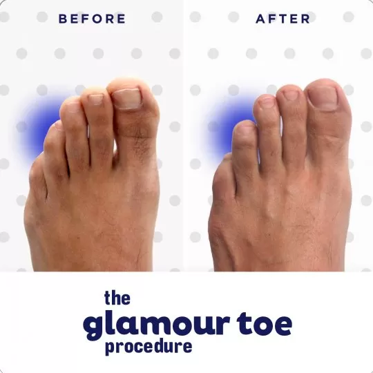 GlamourToe Procedure Before & After Image 04