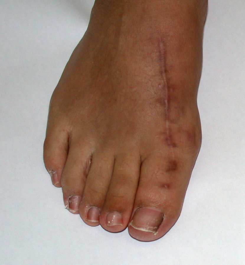 Cosmetic revision foot surgery
